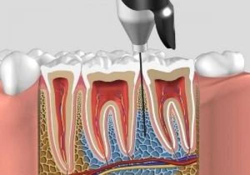 Анестезия у детей в стоматологии. Дозировка 07 Анестезия у детей в стоматологии. Дозировка 07