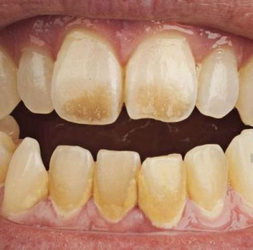 Убрать запах изо рта после алкоголя. Факторы, влияющие на концентрацию и продолжительность запаха 07 Убрать запах изо рта после алкоголя. Факторы, влияющие на концентрацию и продолжительность запаха 07