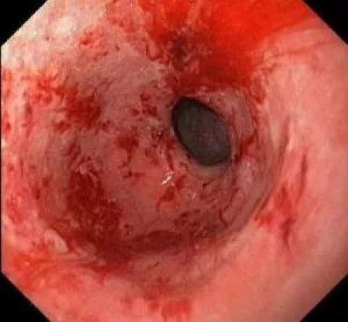 Может ли кашель без простуды быть связан с проблемами желудочно-кишечного тракта. Неинфекционные причины развития патологического рефлекторного процесса