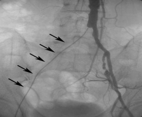 Что нужно знать о периферическом атеросклерозе. Cимптомы, течение 05