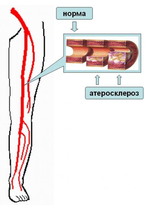 Заболевание периферических артерий и вен. Диагностика ишемии нижних конечностей 05 Заболевание периферических артерий и вен. Диагностика ишемии нижних конечностей 05