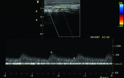 Заболевание периферических артерий и вен. Диагностика ишемии нижних конечностей 02 Заболевание периферических артерий и вен. Диагностика ишемии нижних конечностей 02