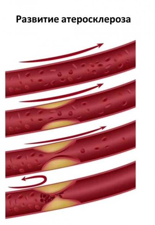 Лечение церебрального атеросклероза сосудов головного мозга. Симптомы атеросклероза сосудов головного мозга 01 Лечение церебрального атеросклероза сосудов головного мозга. Симптомы атеросклероза сосудов головного мозга 01