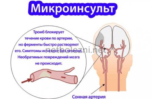 Не пропустите первые признаки инсульта. Симптомы, признаки инсульта 01