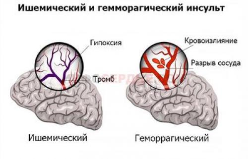 9 самых первых признаков микроинсульта. Предвестники 02 9 самых первых признаков микроинсульта. Предвестники 02