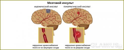 Геморрагический и ишемический инсульты. Ишемический инсульт: признаки и лечение 01