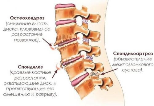 Симптомы грудного остеохондроза у женщин. Полный перечень симптомов грудного остеохондроза у женщин