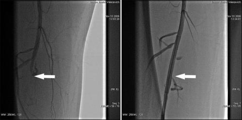 Как новые методы лечения, такие, как стентирование или ангиопластика, применяются при атеросклерозе сосудов ног. Ангиопластика и стентирование артерий нижних конечностей