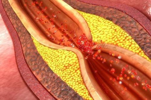 Инфаркт миокарда с подъемом сегмента ST. Краткое описание 02 Инфаркт миокарда с подъемом сегмента ST. Краткое описание 02