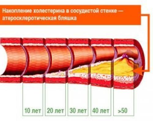Атеросклероз артерий нижних конечностей: Симптомы и методы лечения 02 Атеросклероз артерий нижних конечностей: Симптомы и методы лечения 02