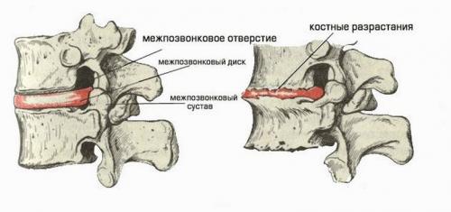 Физические упражнения при остеохондрозе. Общие требования к занятиям