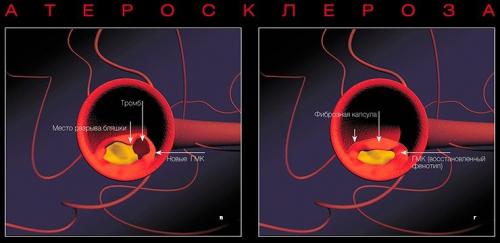 Атеросклероз и его осложнения. Осложнения атеросклероза сосудов головного мозга 01