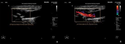 Атеросклероз и его осложнения. Осложнения атеросклероза сосудов головного мозга 02