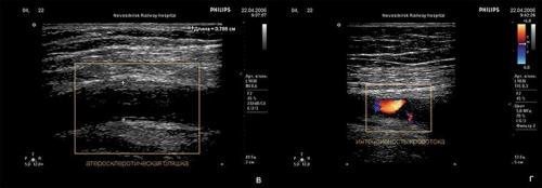Атеросклероз и его осложнения. Осложнения атеросклероза сосудов головного мозга 03
