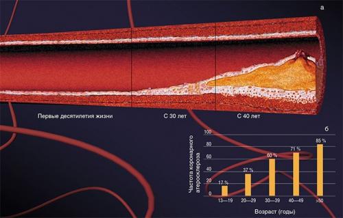 Атеросклероз и его осложнения. Осложнения атеросклероза сосудов головного мозга 04