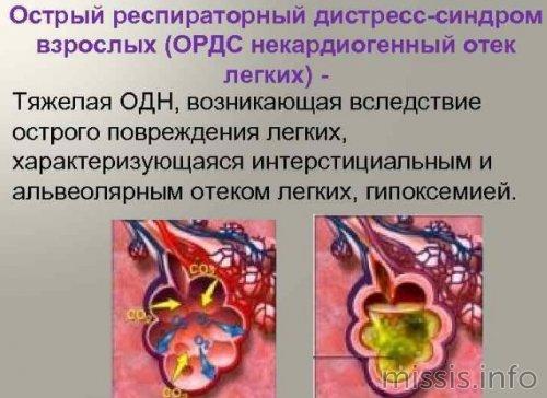 Подъемный ремонт: как вернуть легкие в строй после COVID-19 01