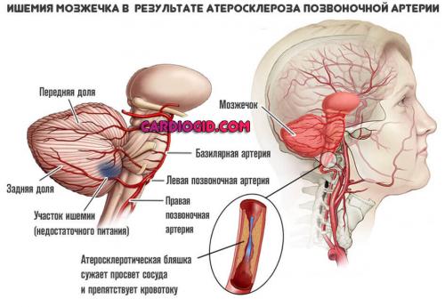 Атеросклероз головного мозга: симптомы. Симптомы атеросклероза сосудов головного мозга, лечение и возможные последствия