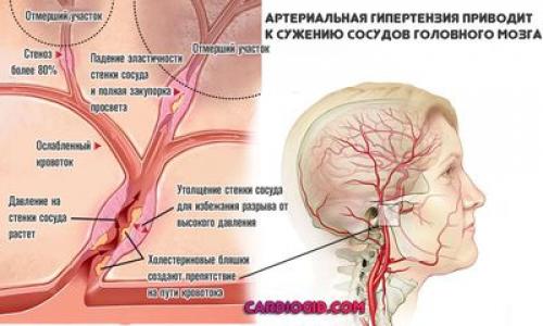 Узкие сосуды головного мозга. Симптомы поражения головы 07