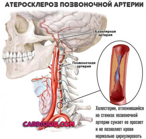 Атеросклероз головного мозга: симптомы. Симптомы атеросклероза сосудов головного мозга, лечение и возможные последствия