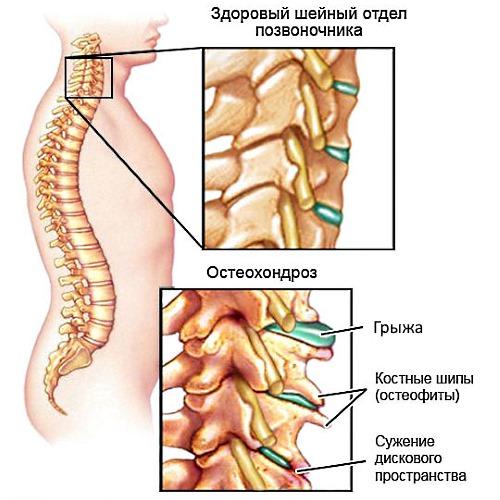 Занятия на турнике при остеохондрозе. Что недопустимо практиковать при остеохондрозе? 03 Занятия на турнике при остеохондрозе. Что недопустимо практиковать при остеохондрозе? 03
