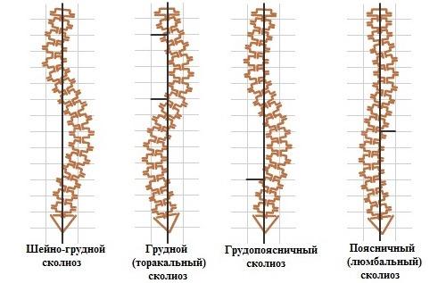 Занятия на турнике при остеохондрозе. Что недопустимо практиковать при остеохондрозе? 02 Занятия на турнике при остеохондрозе. Что недопустимо практиковать при остеохондрозе? 02