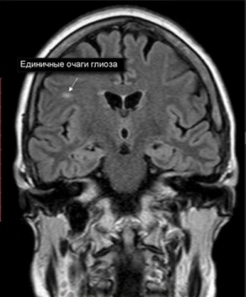 Сколько живут с глиозом. Общие сведения