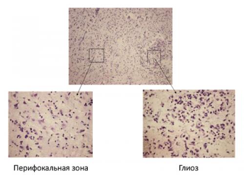 Сколько живут с глиозом. Общие сведения