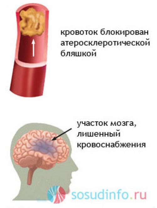 Нестенозирующий атеросклероз. Нестенозирующий атеросклероз экстракраниальных отделов. Атеросклероз экстракраниальных отделов бца. Стенозирующий атеросклероз артерий головного мозга.