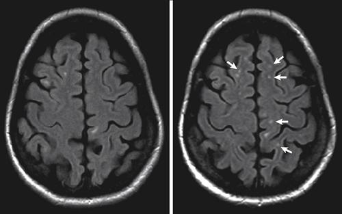 Сколько живут с глиозом. Общие сведения