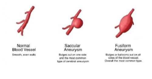Аневризма головного мозга. Причины аневризмы сосудов головного мозга