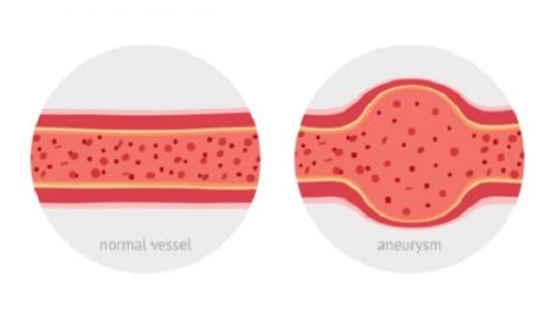 Аневризма головного мозга. Причины аневризмы сосудов головного мозга