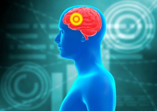 Симптомы аневризмы сосудов головного мозга. Симптомы и диагностика аневризмы сосудов головного мозга у женщин 01 Симптомы аневризмы сосудов головного мозга. Симптомы и диагностика аневризмы сосудов головного мозга у женщин 01