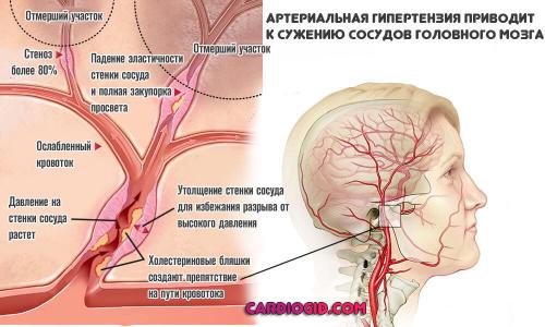 Атеросклероз головного мозга: симптомы. Симптомы атеросклероза сосудов головного мозга, лечение и возможные последствия