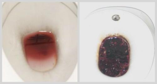 Кровь в рвоте после алкоголя. Алкогольное отравление с рвотой 04