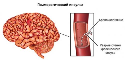 Как улучшить мозговое кровообращение. 10 лучших препаратов для улучшения мозгового кровообращения 02 Как улучшить мозговое кровообращение. 10 лучших препаратов для улучшения мозгового кровообращения 02