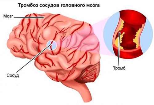 Как улучшить мозговое кровообращение. 10 лучших препаратов для улучшения мозгового кровообращения 01 Как улучшить мозговое кровообращение. 10 лучших препаратов для улучшения мозгового кровообращения 01