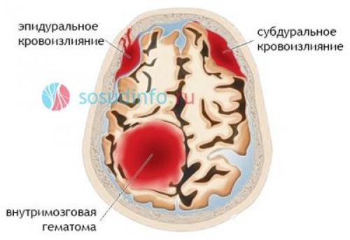 Лечение недостаточности мозгового кровообращения. Нарушение мозгового кровообращения: симптомы, признаки, лечение 01