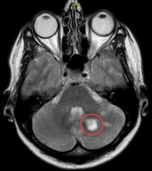 Как можно избежать воспаления лицевого троичного нерва. Обезболивающие не лечат. Найти и устранить источник раздражения нерва
