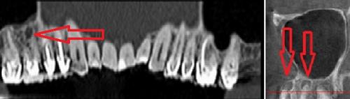 Могут ли другие заболевания влиять на воспаление лицевого троичного нерва. После лечения у стоматолога болит зуб, онемение губы, щеки, боль в лице и челюсти, после лечения пульпита болит зуб