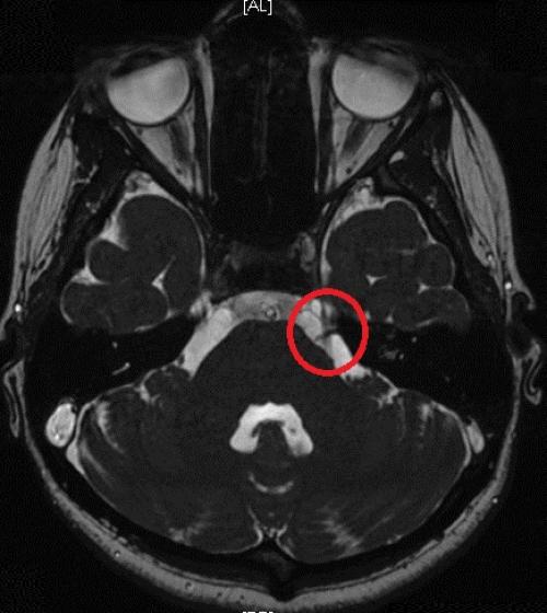 Как можно избежать воспаления лицевого троичного нерва. Обезболивающие не лечат. Найти и устранить источник раздражения нерва