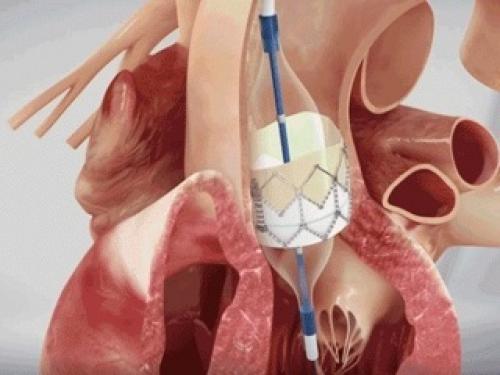 Антитромботическая терапия при TAVI. Результаты исследования POPular TAVI (2020г) 01