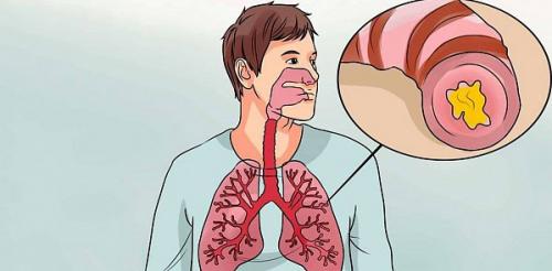 Хронический бронхит у взрослых. Антибиотики при бронхите 01