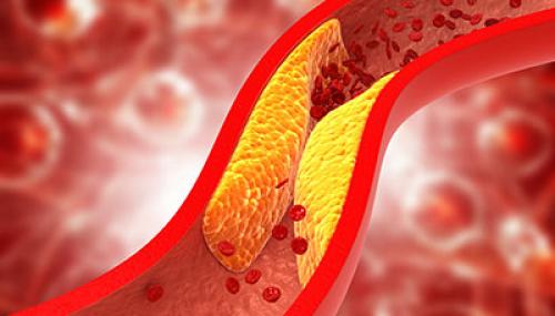 Лечение и вторичная профилактика после инфаркта миокарда. Вторичная профилактика инфаркта миокарда 03