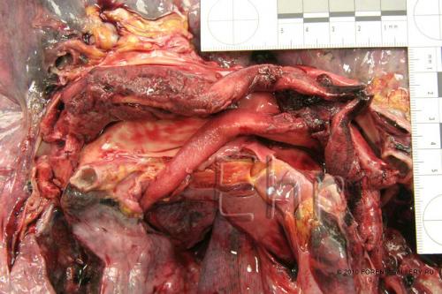 Тромбоэмболия легочной артерии на вскрытии. Тромбоэмболия легочной артерии