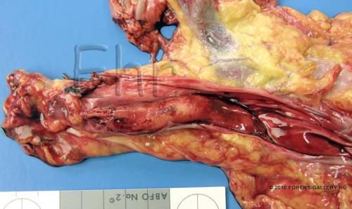 Тромбоэмболия легочной артерии на вскрытии. Тромбоэмболия легочной артерии
