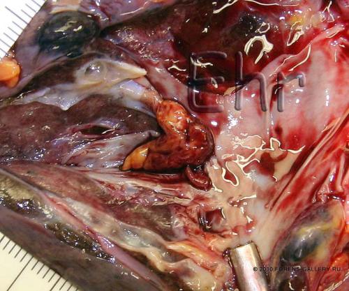 Тромбоэмболия легочной артерии на вскрытии. Тромбоэмболия легочной артерии