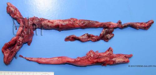 Тромбоэмболия легочной артерии на вскрытии. Тромбоэмболия легочной артерии