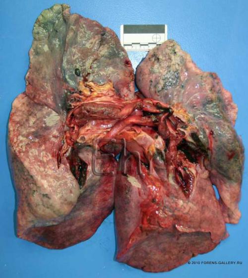 Тромбоэмболия легочной артерии на вскрытии. Тромбоэмболия легочной артерии