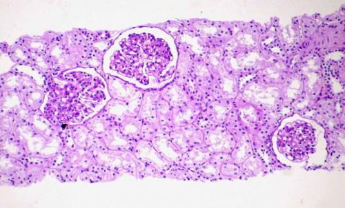 Как алкоголь влияет на работу почек. Губительное действие алкоголя на почки