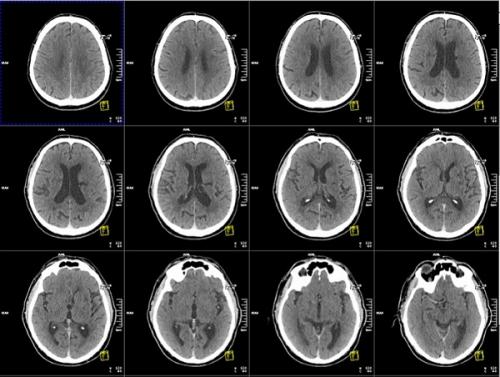 Можно ли самостоятельно проверить состояние сосудов головного мозга. Способы проверки головного мозга кроме МРТ